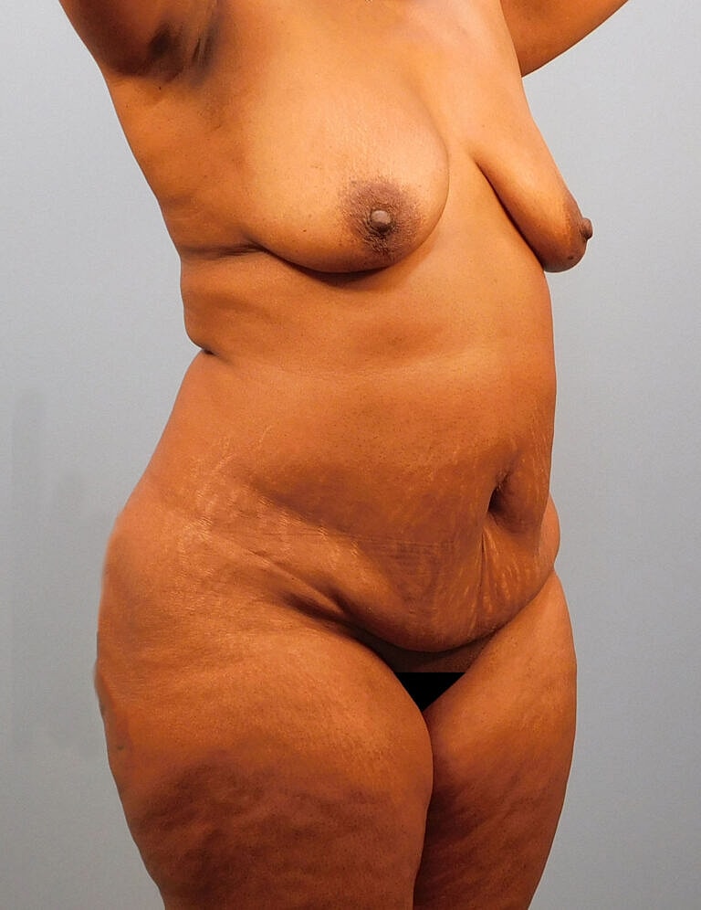 Abdominoplasty Tummy Tuck Before & After