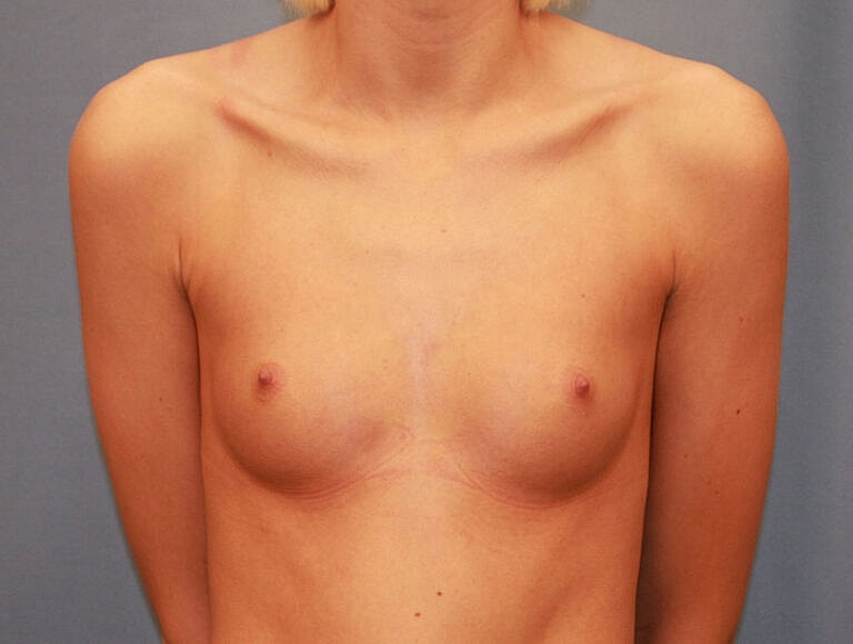 Breast Augmentation Before & After