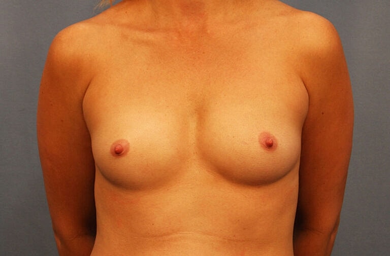 Breast Augmentation Before & After