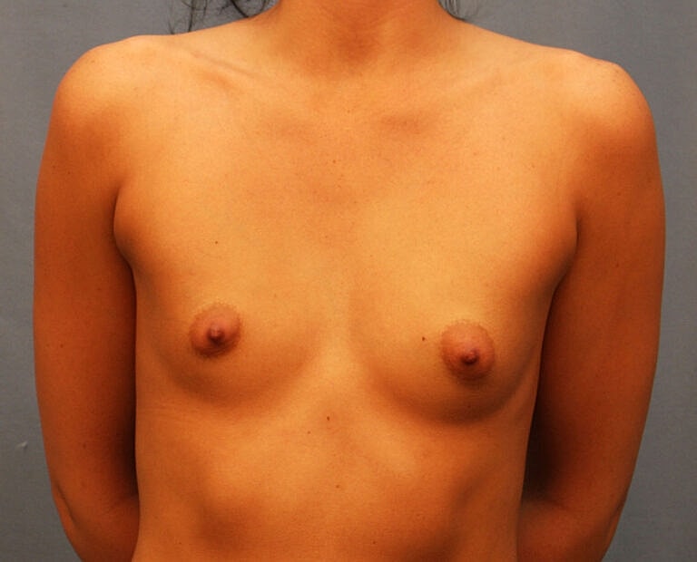 Breast Augmentation Before & After