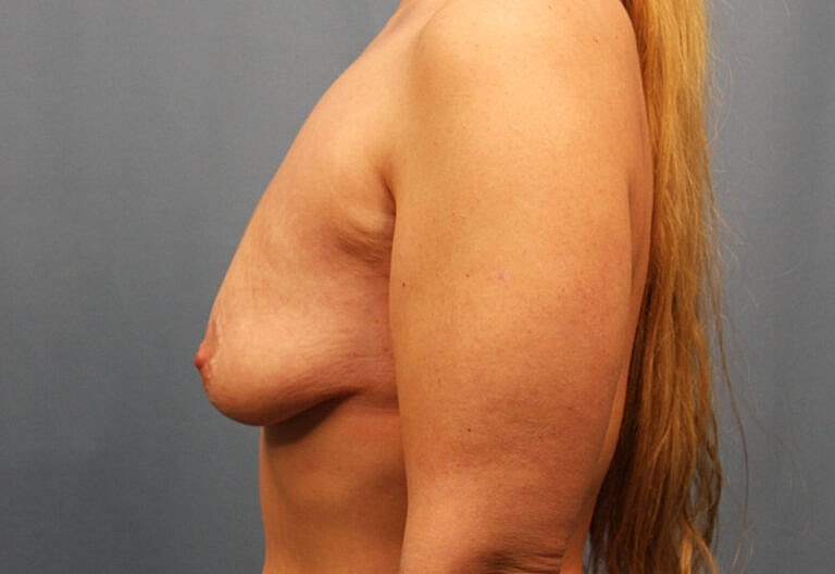 Breast Augmentation Before & After