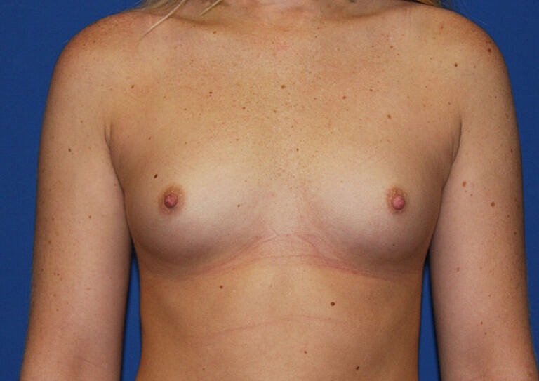Breast Augmentation Before & After