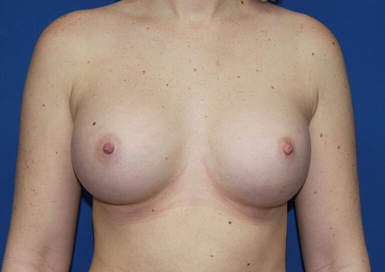 Breast Augmentation Before & After