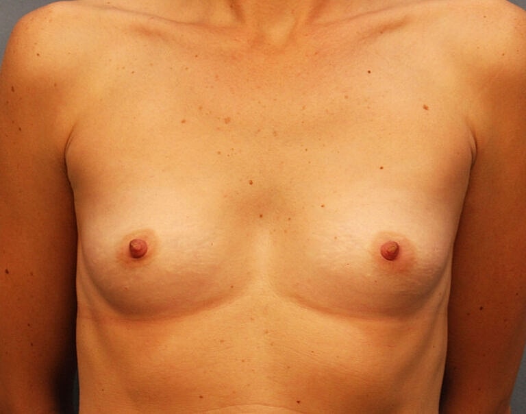 Breast Augmentation Before & After
