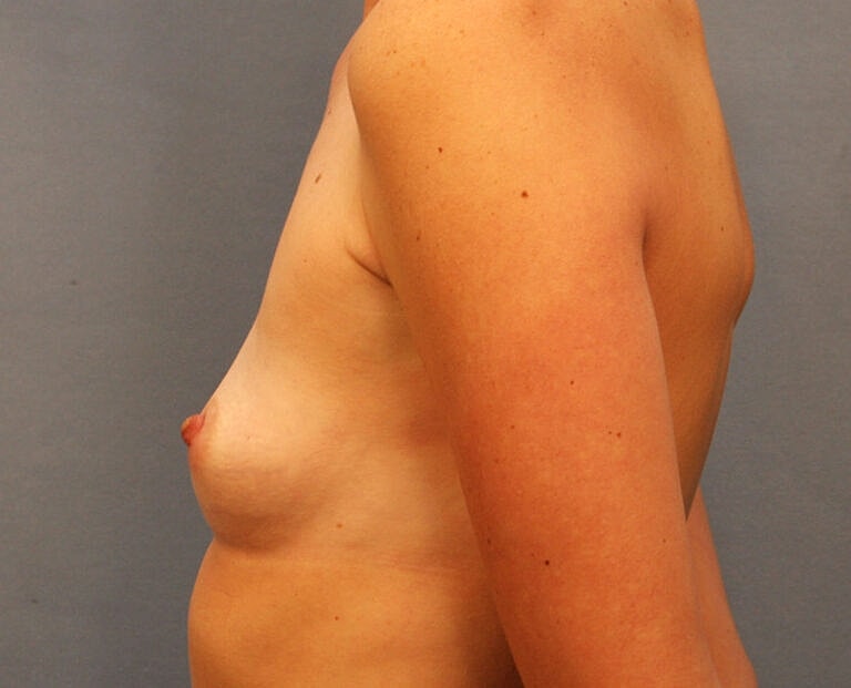 Breast Augmentation Before & After