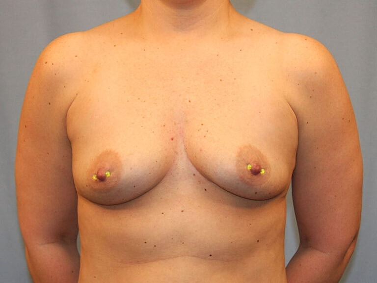 Breast Augmentation Before & After