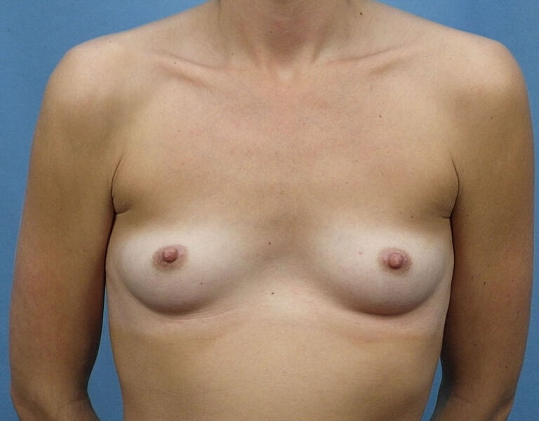 Breast Augmentation Before & After