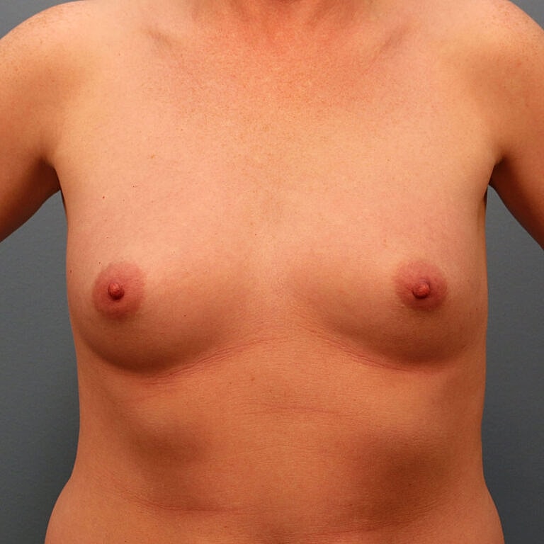 Breast Augmentation Before & After