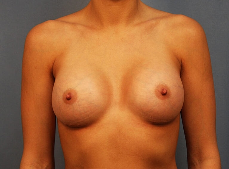 Breast Augmentation Before & After