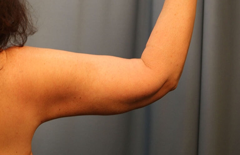Brachioplasty Before & After