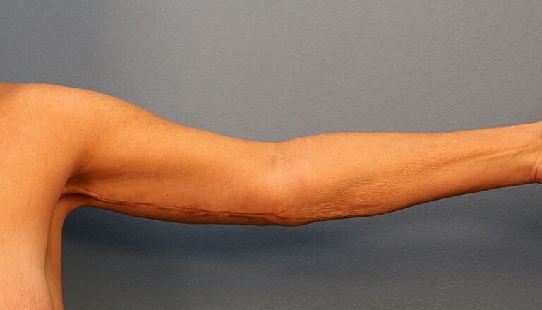 Brachioplasty Before & After